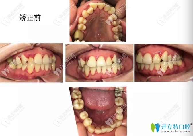 牙齒矯正前照片