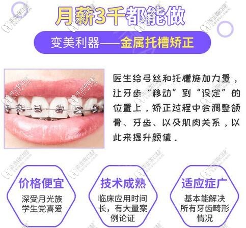 廣州圣貝口腔金屬托槽矯正優(yōu)勢