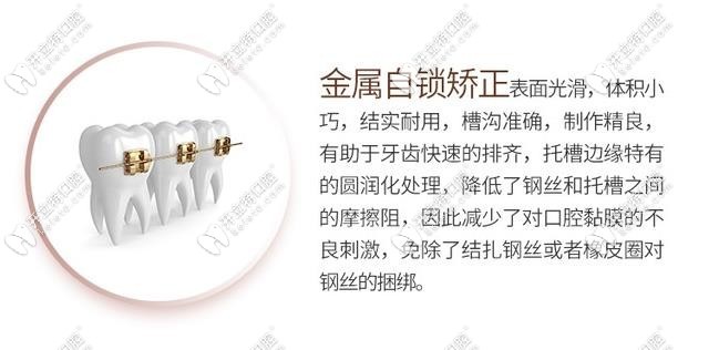 自锁牙套的特点