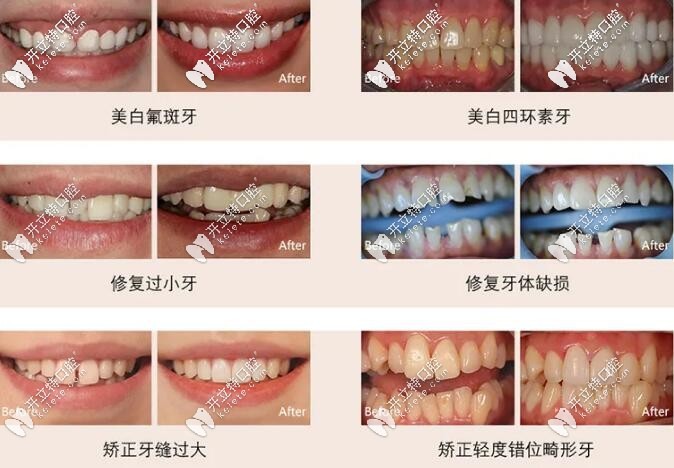 天津中诺口腔瓷贴面适应症