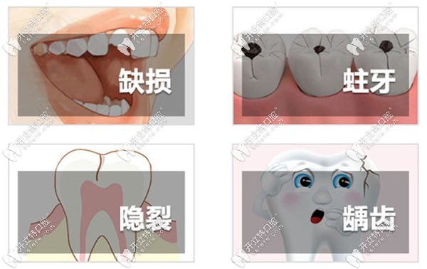 牙齒需要補牙的情況