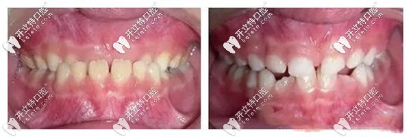 杨春犁医生儿童反颌矫正案例