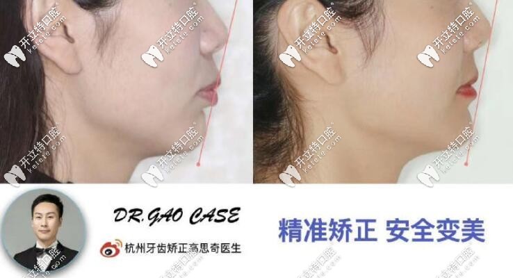 凸嘴龅牙矫正前后脸型对比图
