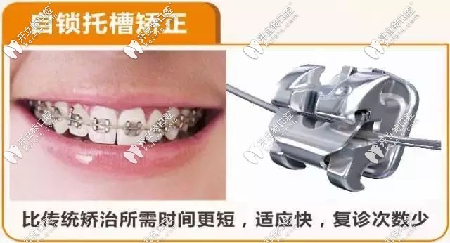 金屬自鎖托槽矯正