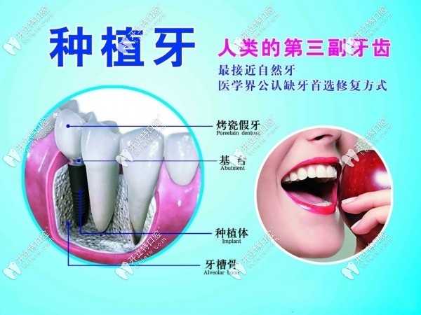 種植牙結(jié)構(gòu)