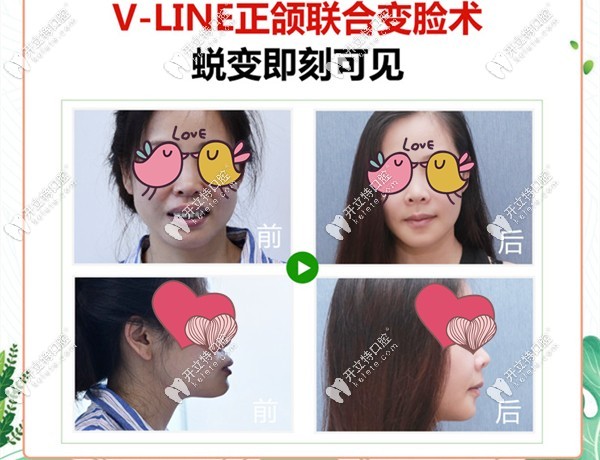 何錦泉博士的正頜病例