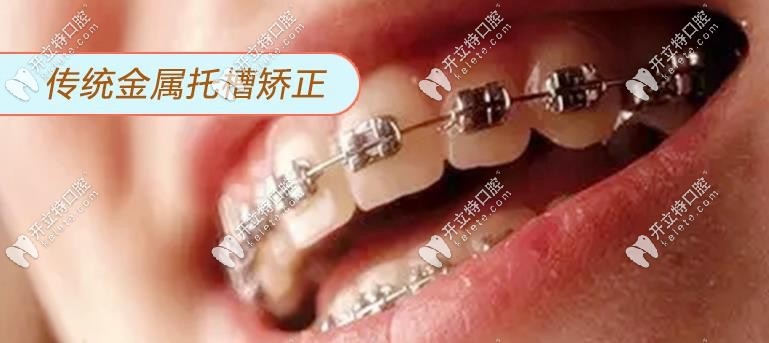 金屬矯正托槽外觀