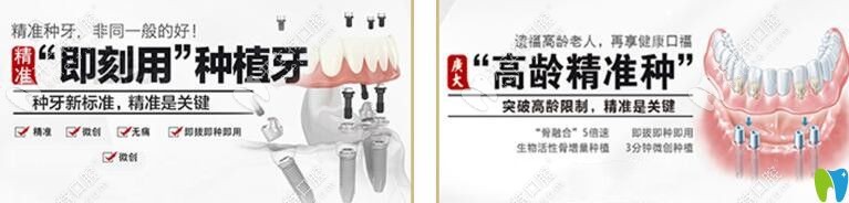 广大口腔即刻种植与精准种植的图示