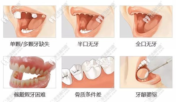 福能海峽口腔的種植牙多少錢