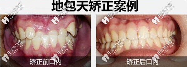 深圳格倫菲爾口腔地包天牙齒矯正案例