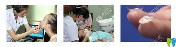 廣州曙光口腔全瓷貼面安裝過程