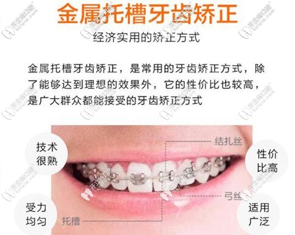 昆明美奧口腔金屬托槽牙齒矯正