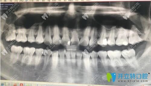 在廣州曙光口腔拍的牙齒片子