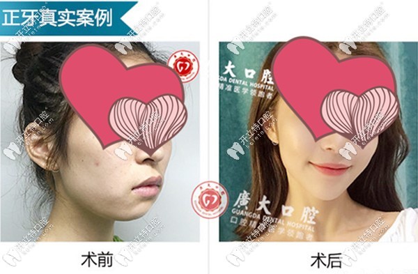 凸嘴手術(shù)前后<span style=