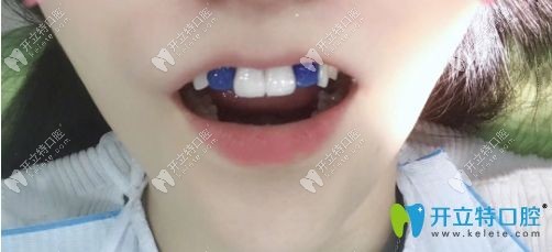 做牙齒貼面前的樣子