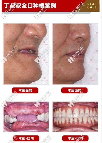 程叔叔在京一口腔做全口种植牙病例