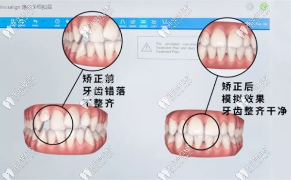 三维动画模拟矫正前后对比