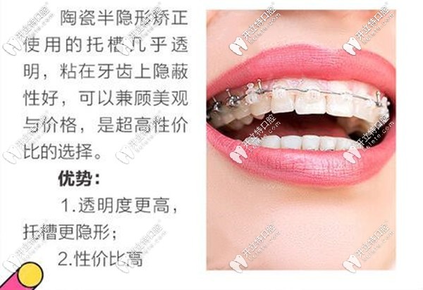 昆明美奧口腔進(jìn)口陶瓷半隱形矯正器