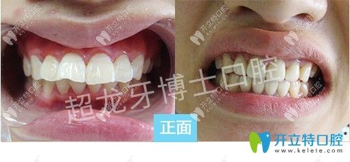長春牙博士王聰醫(yī)生成人深覆蓋牙齒矯正前后對比案例圖