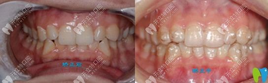 <!--<i data=20240703-sp></i>-->齒科牙齒深覆頜矯正案例