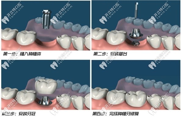 種植牙操作流程示意圖