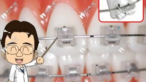 自鎖托槽矯正