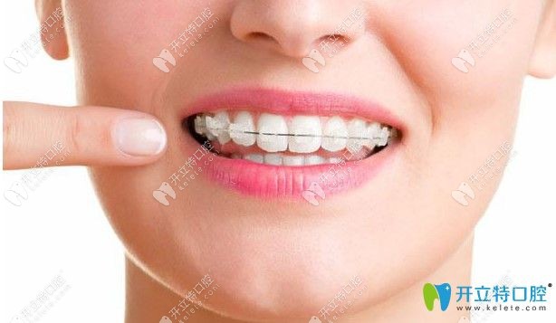 廣大口腔陶瓷自鎖矯正技術(shù)