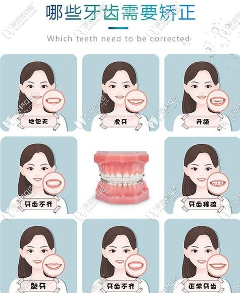牙齒畸形類型