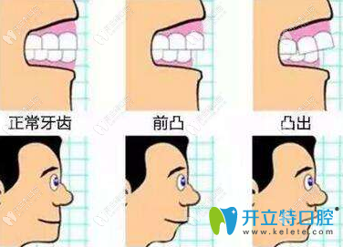 矯正牙齒和牙齒畸形的程度有關 矯正牙齒和牙齒畸形的程度有關