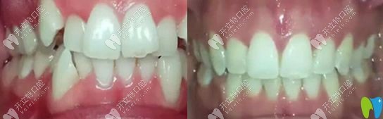 深圳河山齒科牙齒矯正怎么樣？看顧客矯正牙齒真人案例及評價