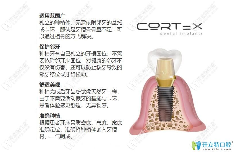 科斯特種植體優(yōu)點