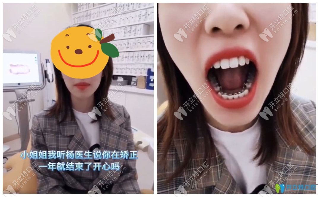 高顏值小姐姐也選擇楊國平做了舌側(cè)牙齒矯正