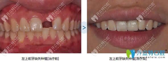 泉州维乐口腔即刻种植牙案例图