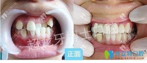 長春超龍牙博士王聰主任虎牙和地包天矯正前后對比照