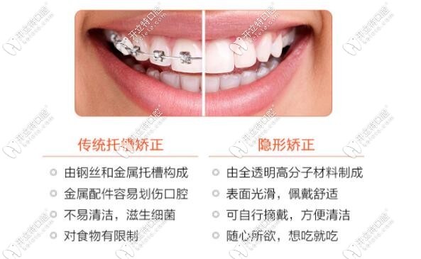 隐形牙套和金属牙套的区别