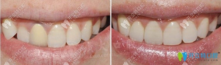 廣大口腔牙貼面修復(fù)對(duì)比圖