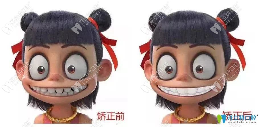 哪吒牙齒矯正前后對比圖
