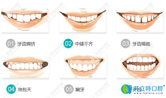 需要矯正牙齒的6種類型 需要矯正牙齒的6種類型