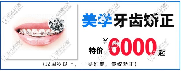 传统金属托槽矫正价格6000元起；