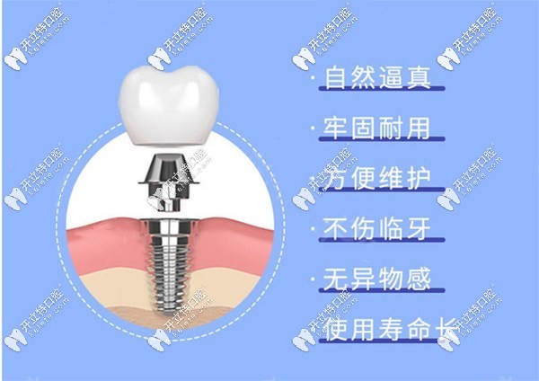 国产种植体cdic真的不错