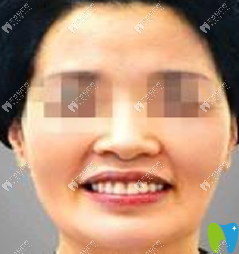 寧波牙博士口腔種植牙案例術(shù)后效果