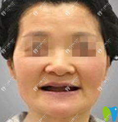寧波牙博士口腔種植牙案例術(shù)前照