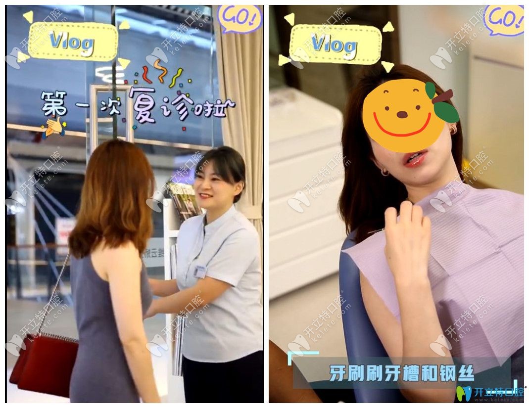 在<!--<i data=20240703-sp></i>-->維樂口腔做舌側(cè)矯正后來復(fù)查