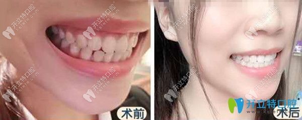 隐形矫正前后效果图