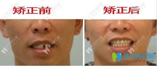 廣州偉聯(lián)口腔反頜矯正前后對(duì)比圖