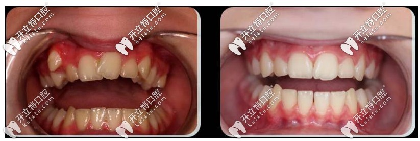 mrc儿童矫治器（MRC肌功能矫治）效果