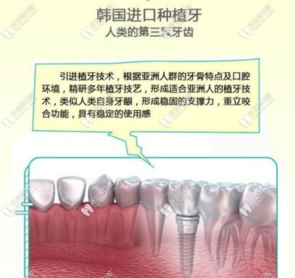 深圳健康齒科種植牙價格表