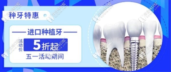 进口种植牙活动