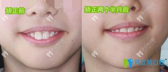 20180802434682.jpg乳牙反頜矯正時(shí)期：5歲乳牙反頜矯正案例