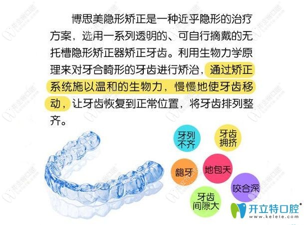 博思美隱形矯正介紹圖示